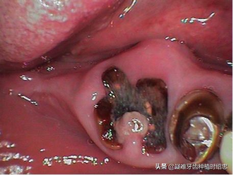 只剩残根的牙真的能补救吗,烂的只剩下黑色残根的牙怎么处理