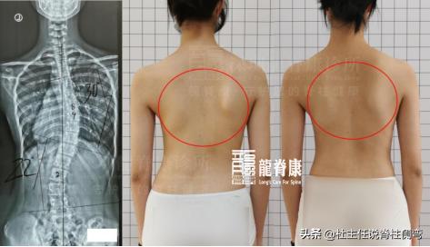 脊柱侧弯最好的恢复方法拉单杠,吊单杠可以纠正脊柱侧弯驼背吗