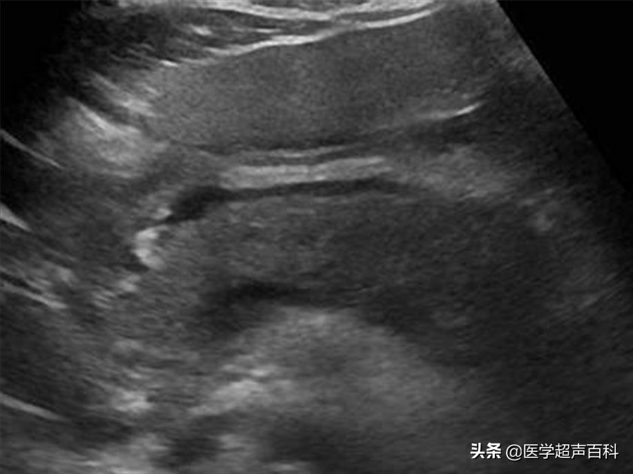 常见的消化系统疾病——急性胰腺炎，超声表现、诊断及治疗