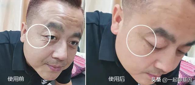 大眼袋眼纹抹平了,眼纹医美怎么去除