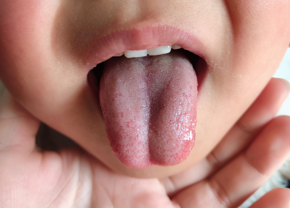 儿童中焦湿热怎么调理,小孩体质脾虚气阴两虚怎么调理