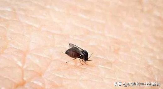 号称“万能皮肤药”的炉甘石洗剂，究竟应该怎么用？