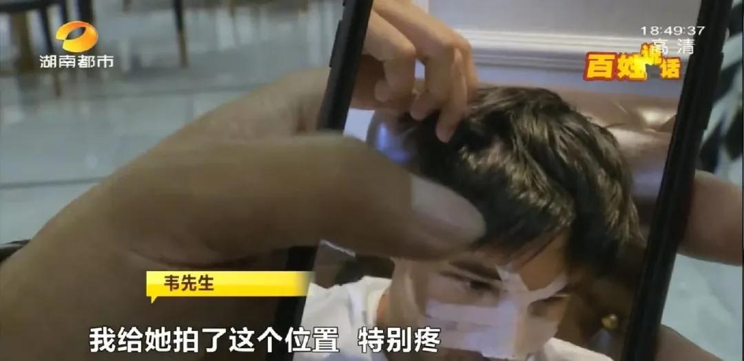 长沙29岁小伙接受5项整形，术后头皮坏死致大面积脱发！《民法典》侵权责任编：须告知医疗风险并征得同意