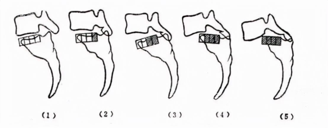 腰椎滑脱可否进行腰椎牵引,腰椎滑脱能否造成腰椎狭窄