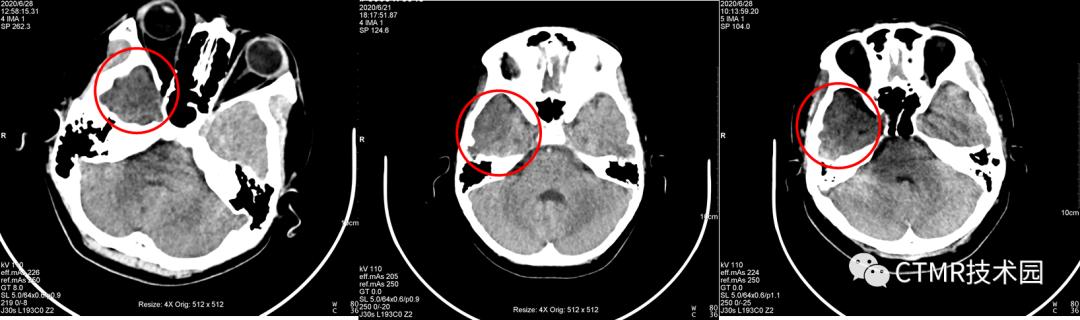 CT影像技术,脑部做ct有伪影是怎么回事