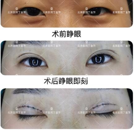 听说有眼袋又有泪沟怎么弄,眼下脂肪多就可以有卧蚕吗