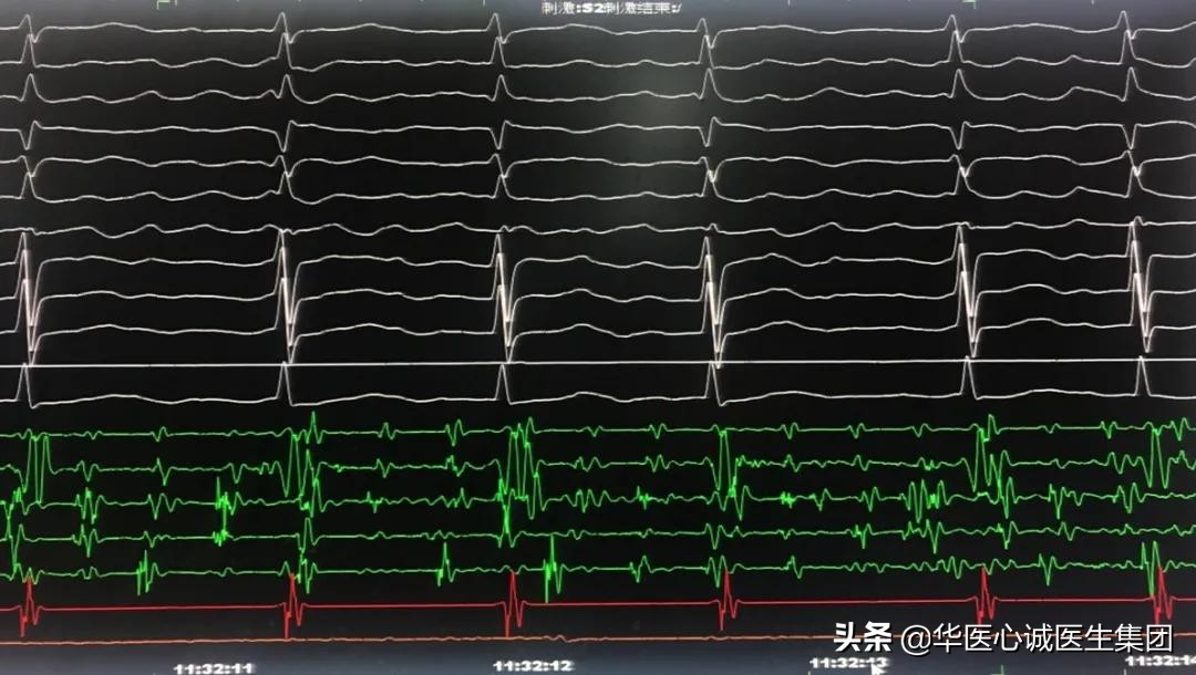 窦性心动过速查房,攀钢集团总医院心内科