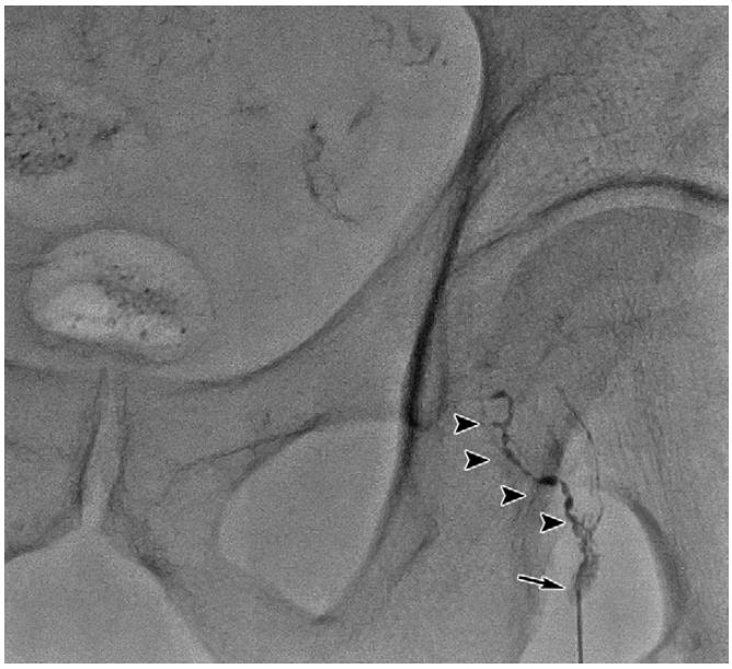 盆腔囊性淋巴管瘤可以治愈吗,盆腔淋巴管囊肿