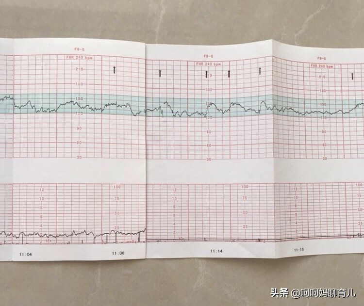 孕晚期胎监不好医生要催生,孕晚期胎监不过要求剖腹