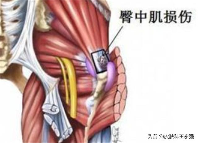 坐久了臀部疼肌肉劳损,久坐臀肌劳损怎么治