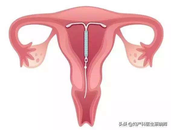 关于科学避孕的问题讨论,年轻人避孕哪种方法好
