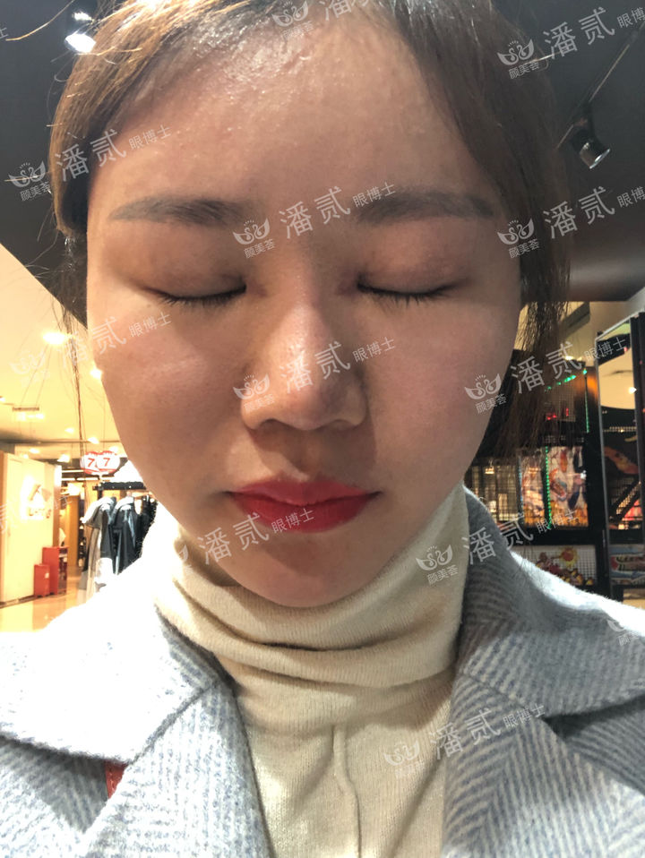 开眼角过大图片,开眼角过大修复效果图