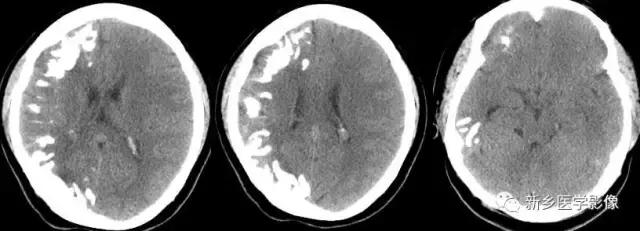 颅内有钙化怎么治疗,34岁脑部有钙化正常吗