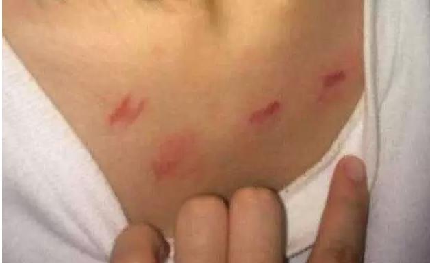 发现孩子有草莓印,被家长发现有草莓印