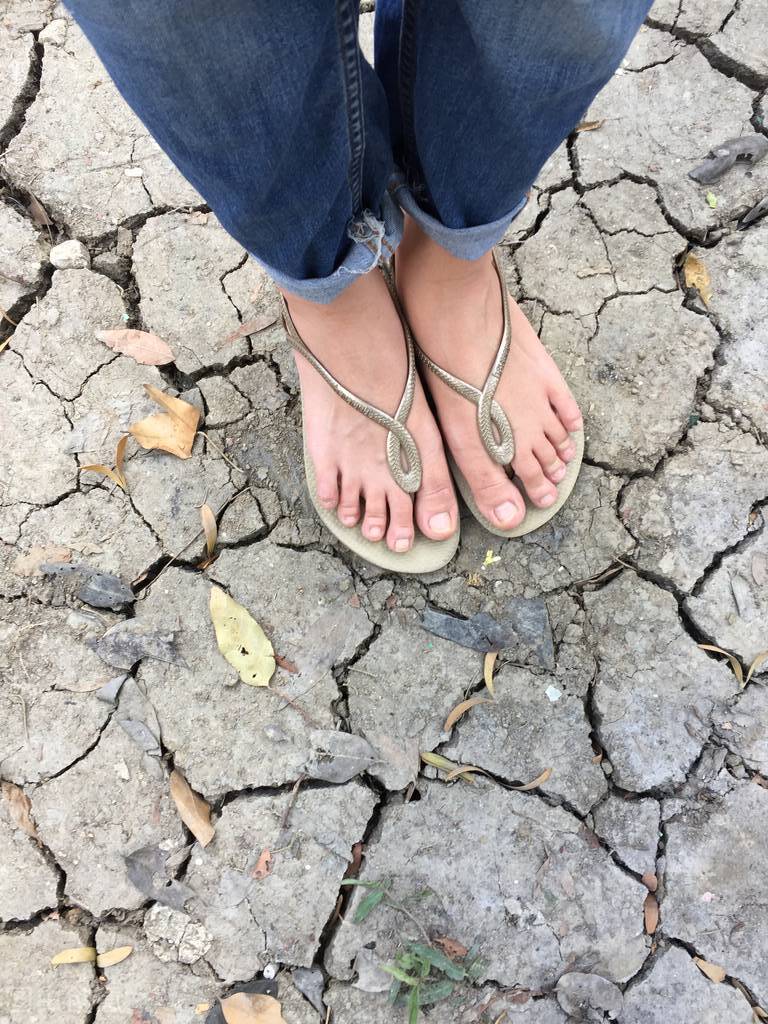 不规则痣一定是黑色素瘤,怎么判断黑色素痣或瘤