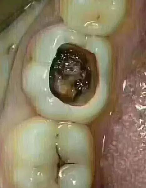 吓！10岁小孩就要靠假牙吃饭，妈妈记住这9招保护好孩子的牙