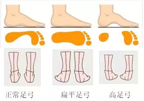 足部ct可以看出是不是扁平足吗,孩子脚部知识