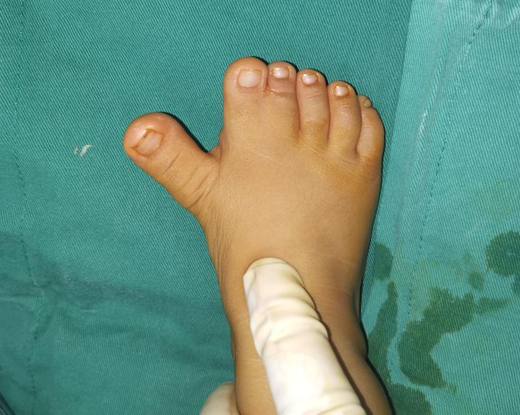 并指畸形免植皮案例,并指畸形