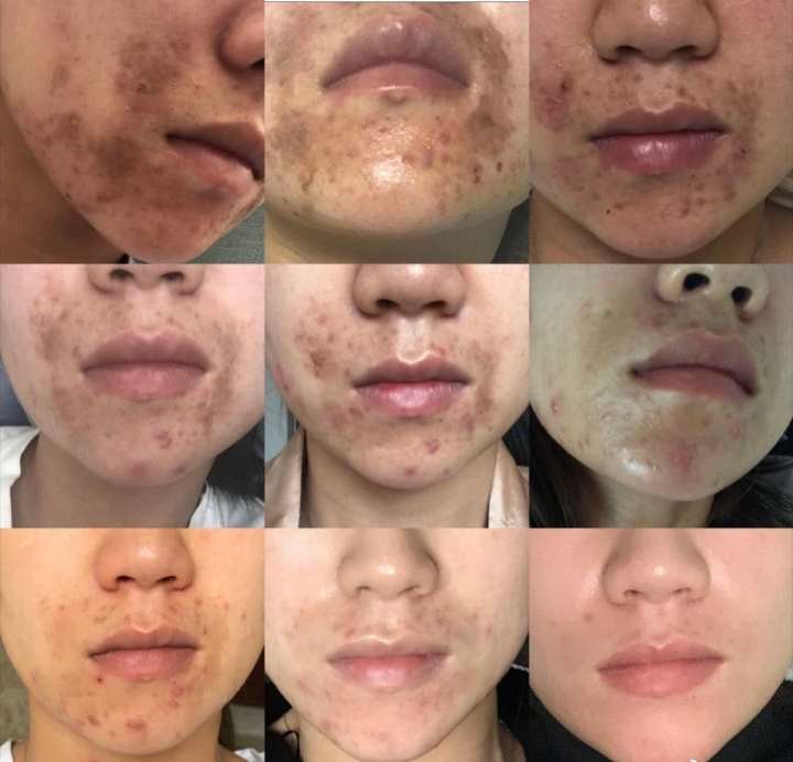 祛除疤痕痘印痘坑药膏,祛除痘印痘坑护肤品