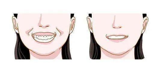 矫正牙齿打骨钉疼不疼,小孩矫正牙齿疼不疼