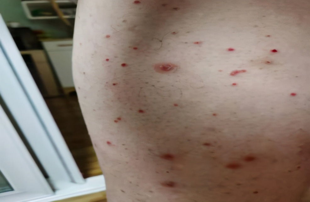 病例分享｜银屑病8年患者，采用中药调理，半个月就见好转