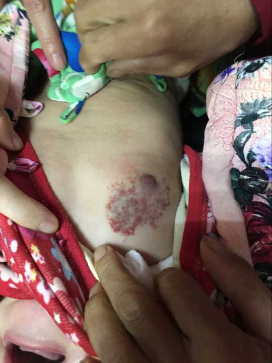 血管瘤病人怎么护理？