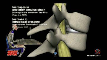 腰椎间盘突出症的看过来,看腰椎间盘突出的视频