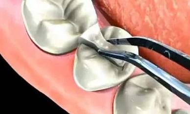 牙齿破损一小点什么原因,牙齿有小黑点医生不处理直接补上