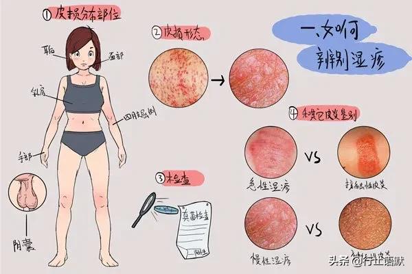 儿童手部湿疹艾灸取穴,穴位治湿疹最有效的方法