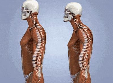 一个动作判断你是不是翘臀,你以为的翘臀很可能是骨盆前倾