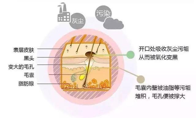 皮肤科医生建议去黑头的方法,皮肤科医生推荐去黑头方法