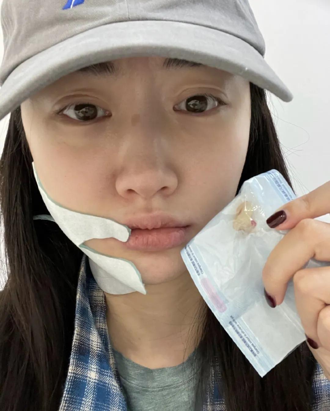 景甜素颜曝光认不出，自拍双眼皮疤痕明显，曾大方承认自己整容