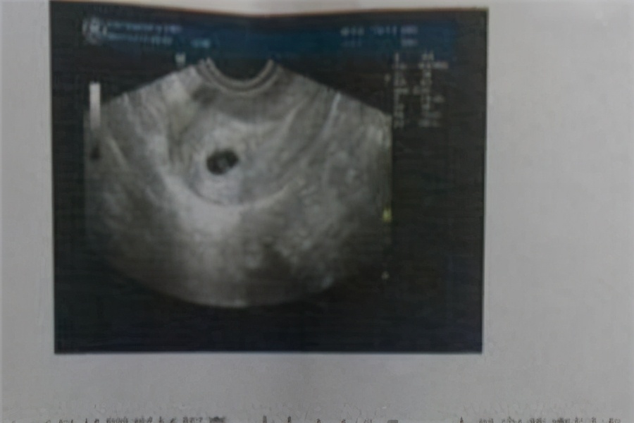 41岁药流的过程和注意事项,药流过程中怎么做能快速排出孕囊