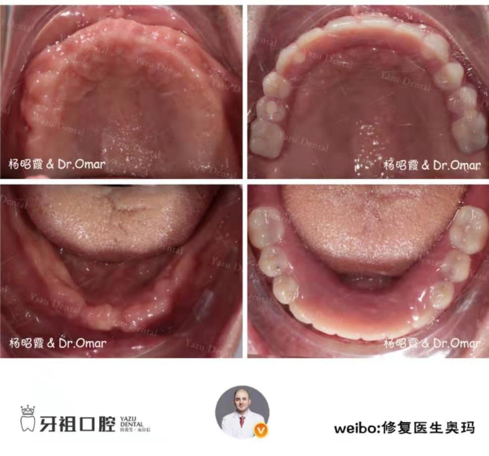 半固定种植牙几个牙钉,球帽式半固定种植牙优缺点