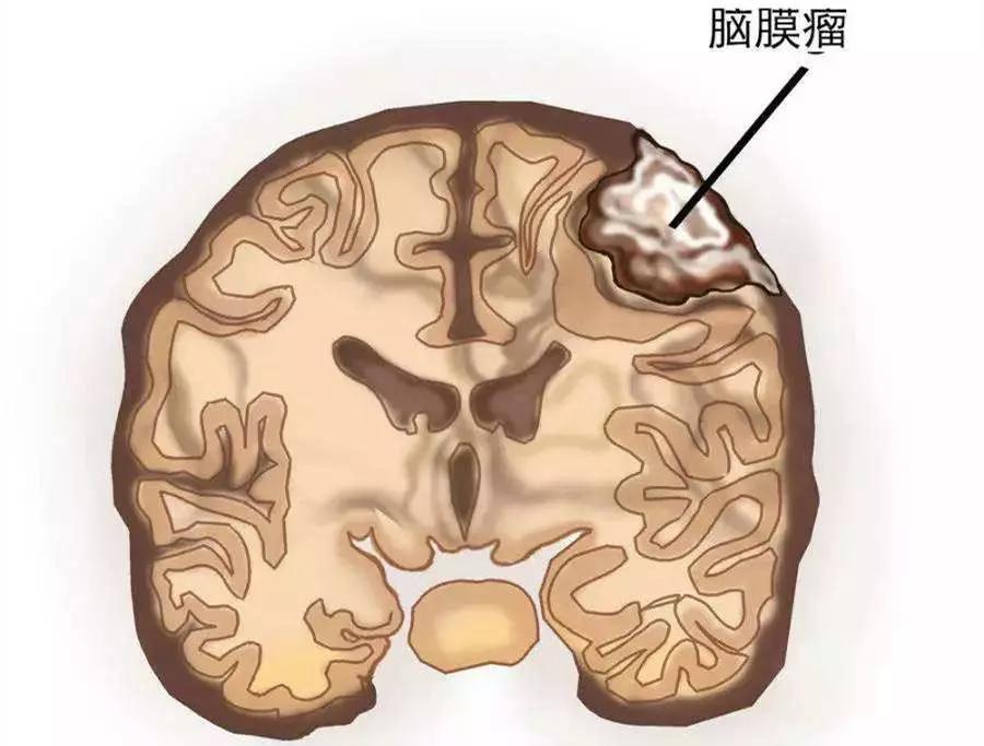 侵蚀颅骨的脑瘤是不是良性,脑膜瘤颅骨侵蚀后怎么办