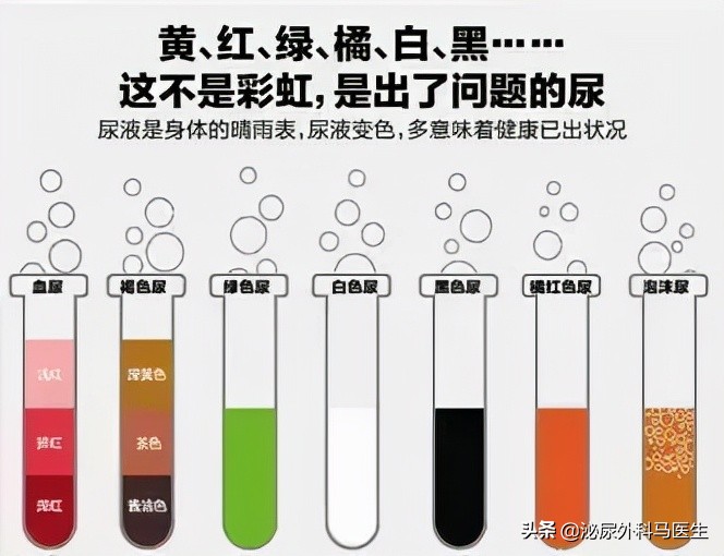 尿液里会有固体吗,尿液里会有沉淀物吗