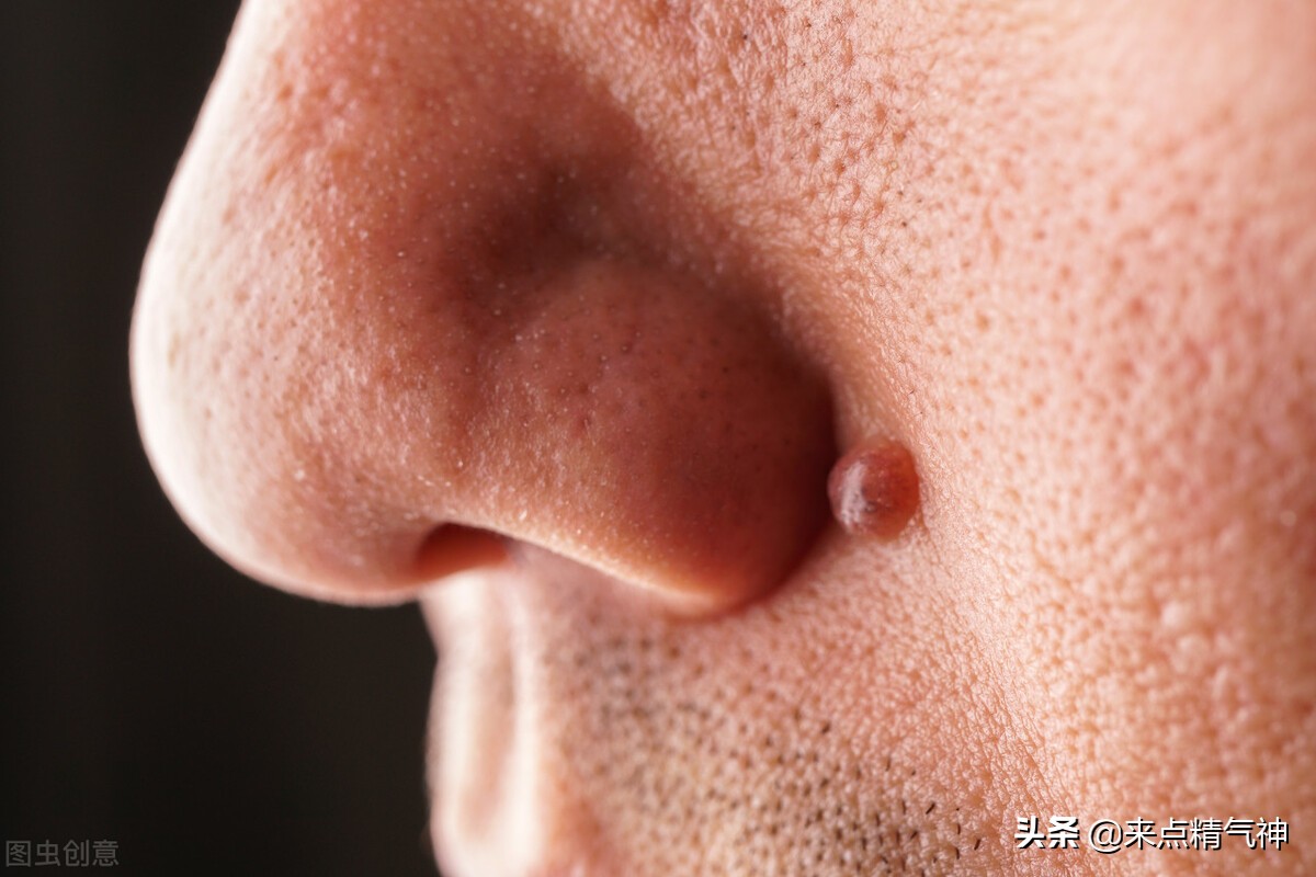 脸上的痣越长越大和癌症的关系,脸上长痣好不好专家回答