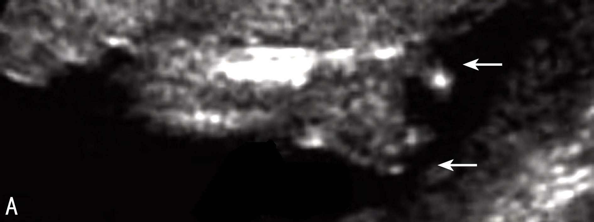 明明白白做超声30-9:肢体发育不全