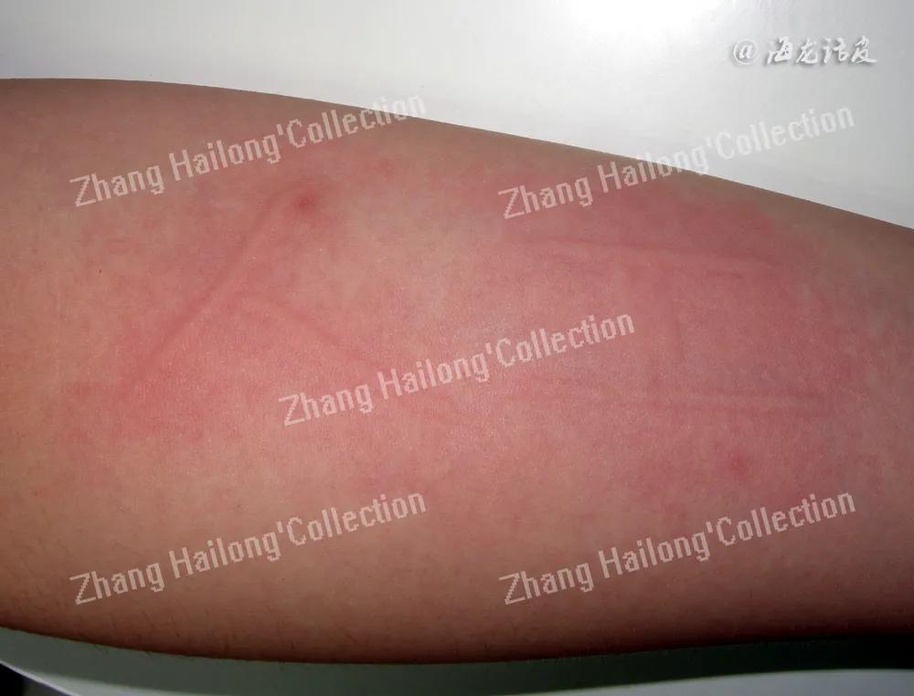 儿童麻疹的防治措施,儿童荨麻疹断根的土方法