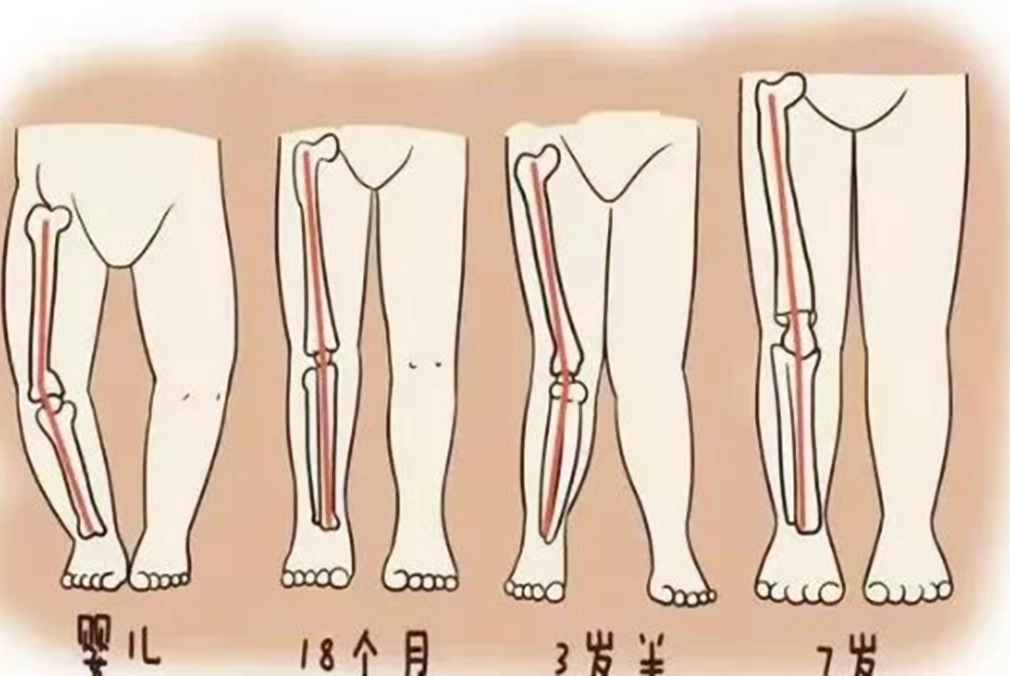 什么原因会导致孩子罗圈腿,孩子有点罗圈腿怎么矫正