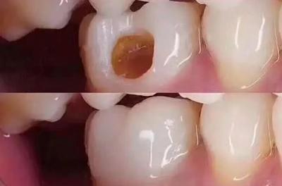 牙齿破损一小点什么原因,牙齿有小黑点医生不处理直接补上