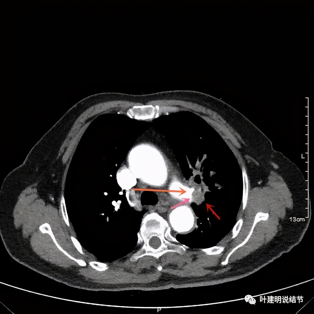 中央型肺癌手术前辅助治疗,中央型肺癌治疗后活过10年的病例