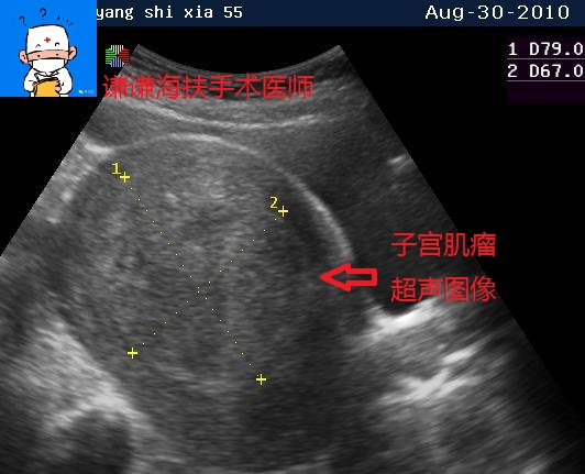 子宫内膜肌瘤鉴别诊断,子宫肌瘤的鉴别诊断以及鉴别要点