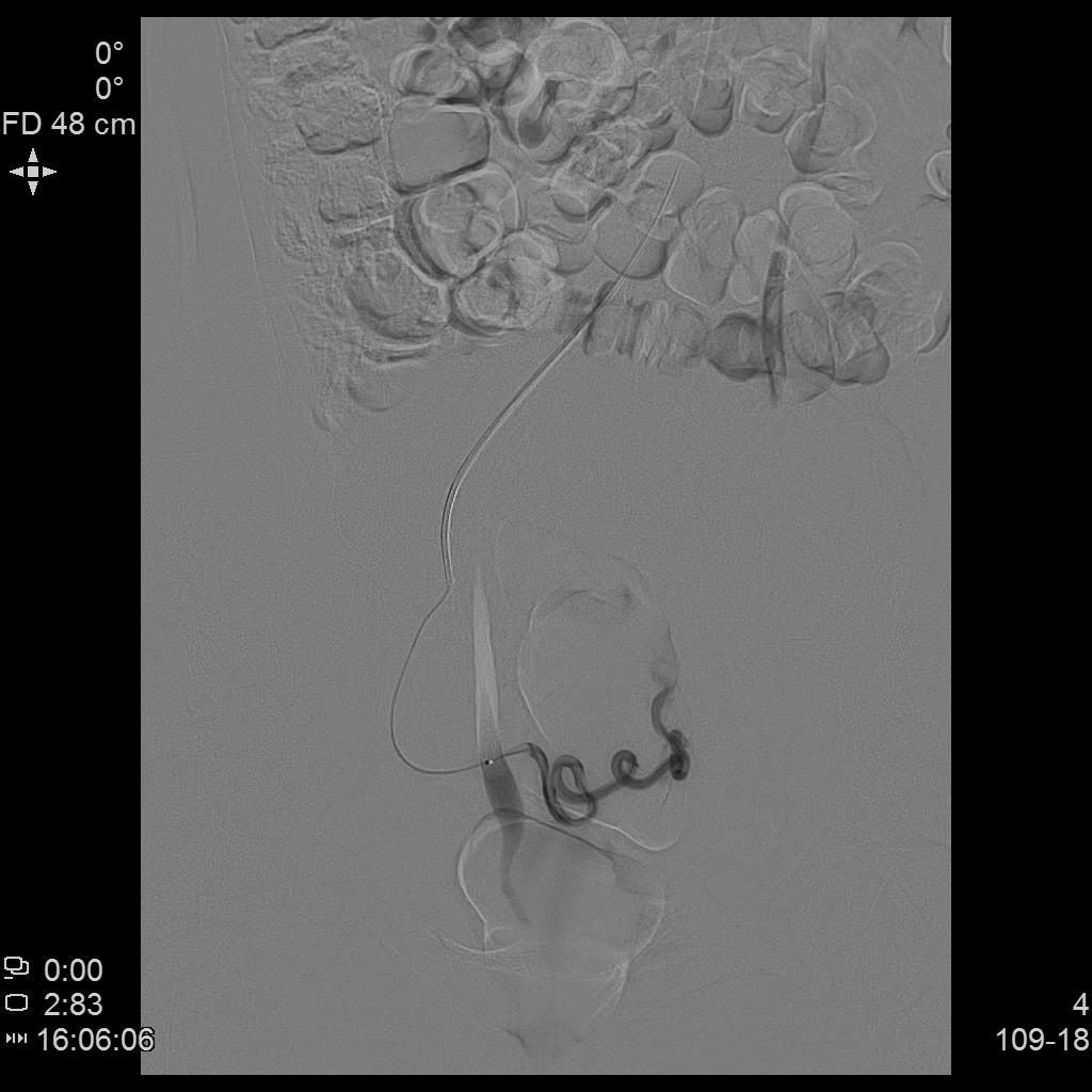 子宫肌瘤不能开刀只能化疗严重吗,子宫肌瘤介入栓塞治疗后注意事项