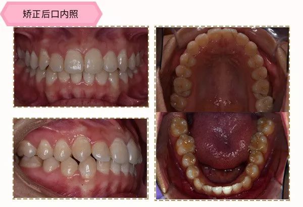 有兔牙如何改善,兔牙怎么矫正