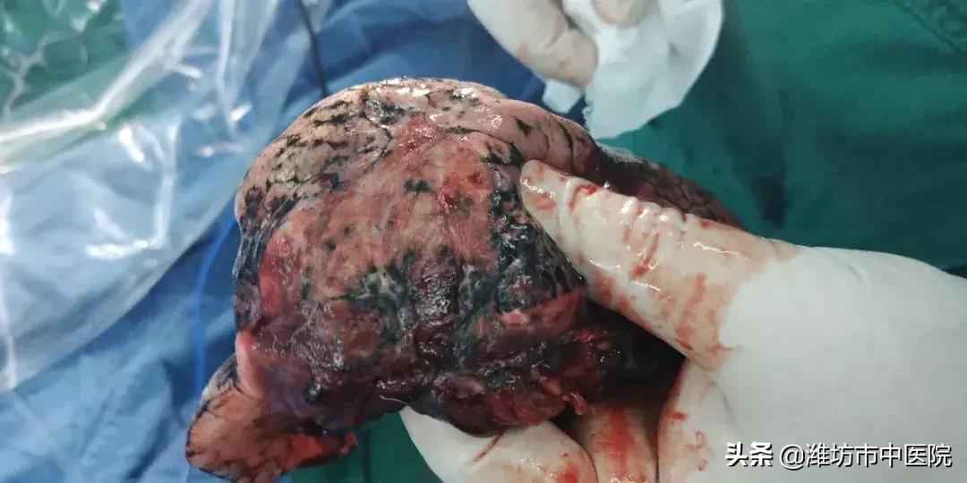 肺癌晚期肝转移肾转移能活多久,肺癌晚期肾转移有哪些表现