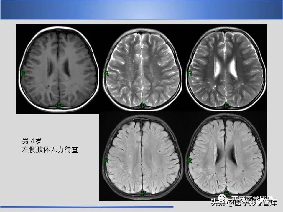 vr间隙概念,vr间隙需要做什么检查