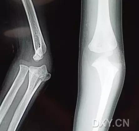 几种严重骨折医学名称,常见的骨折有哪些名称