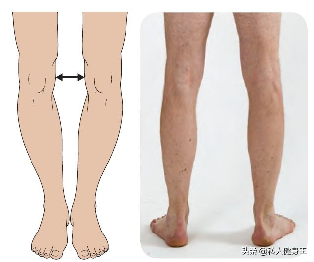 内旋型o型腿与外旋型o型腿的区别,40至50岁的o型腿能矫正过来吗