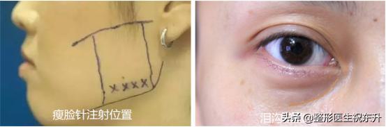 刚打完瘦脸针医生就让冰敷了,瘦脸针和玻尿酸一起打影响效果吗